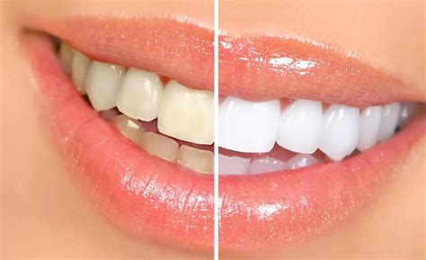 sararan dişler nasıl beyazlatılır
